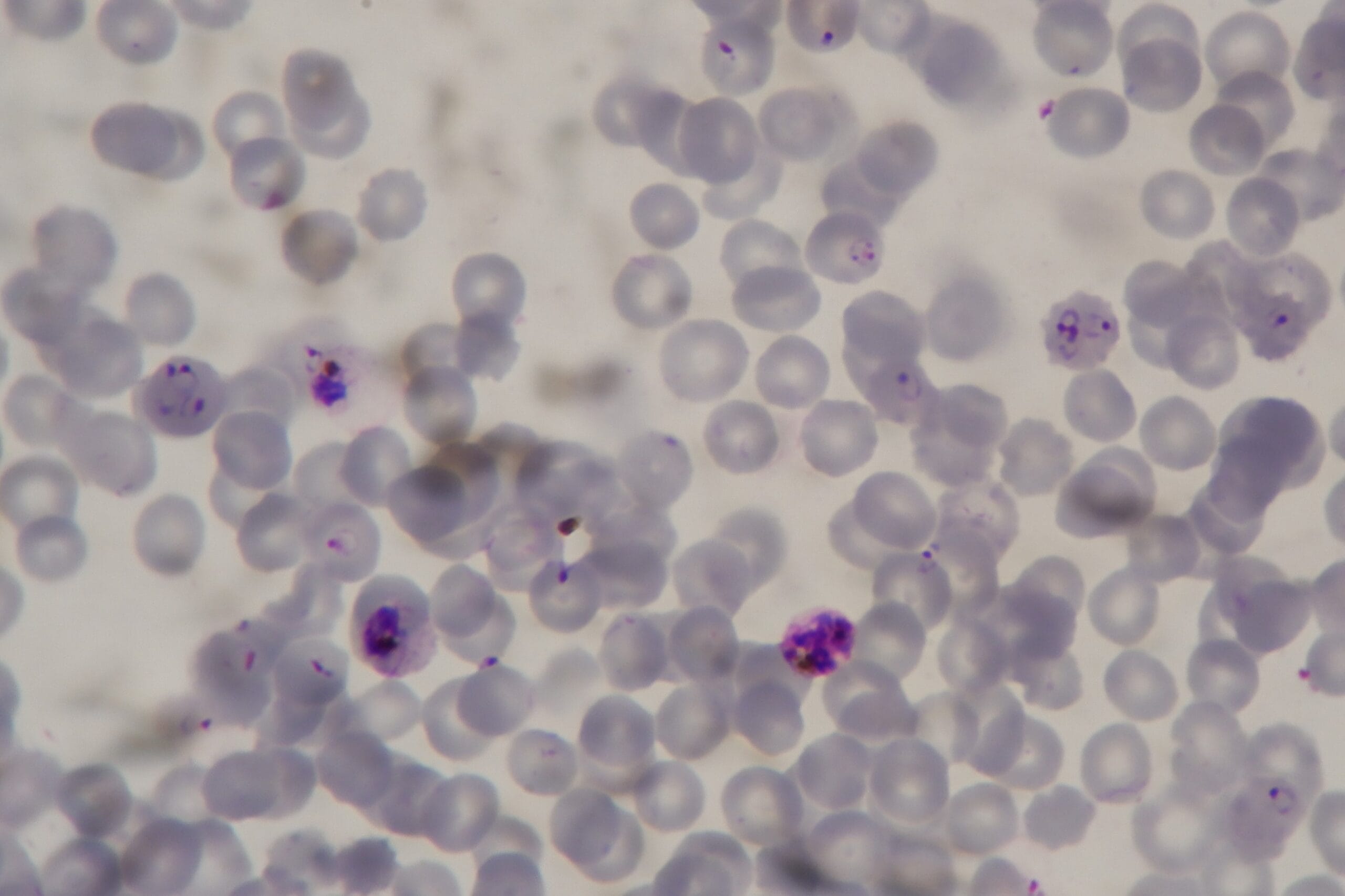 Malaria parasites in blood sample under the microscope